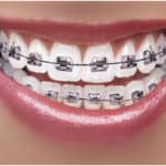 TMJ after braces orthodontics