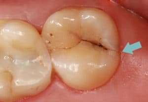 cirugía de implantes dentales inmediatas