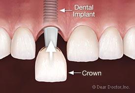 dental implant healing time