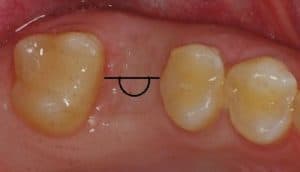 problemas de implantes dentales
