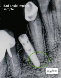 implant complications