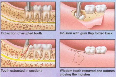 wisdom teeth infection before removal