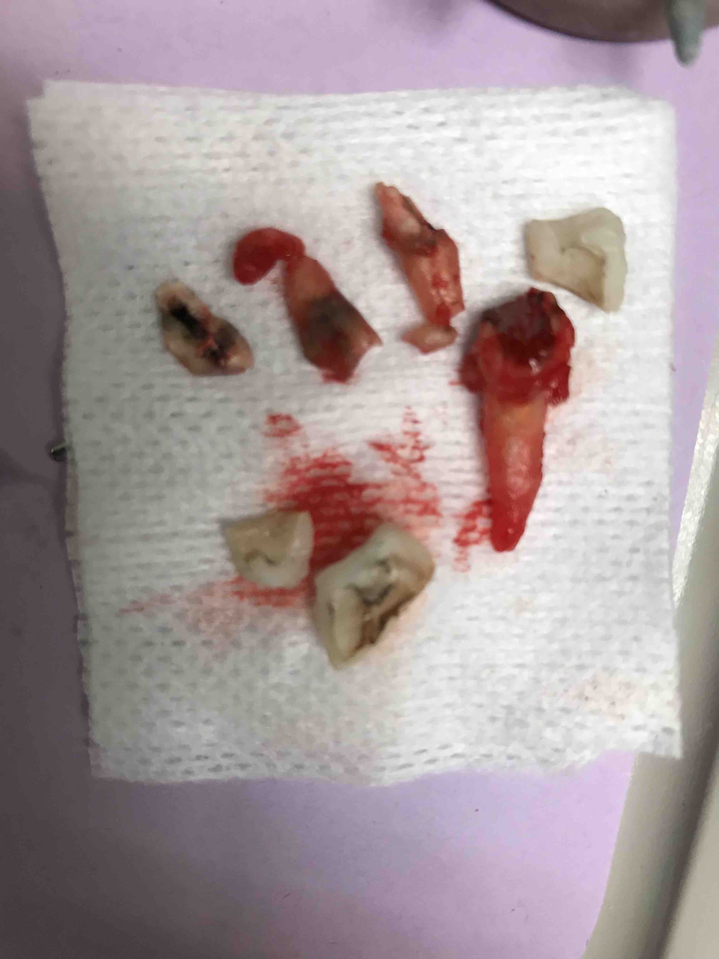 root canal removal