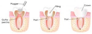 root canal removal technique