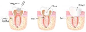 Técnica de extracción del conducto radicular