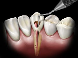 traitement de canal ou extraction avec implant