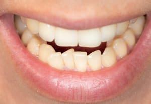 teeth crowding braces tmj