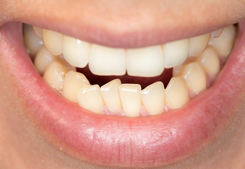 teeth crowding braces tmj