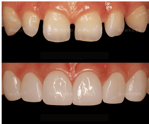 close teeth spaces with braces causes TMJ