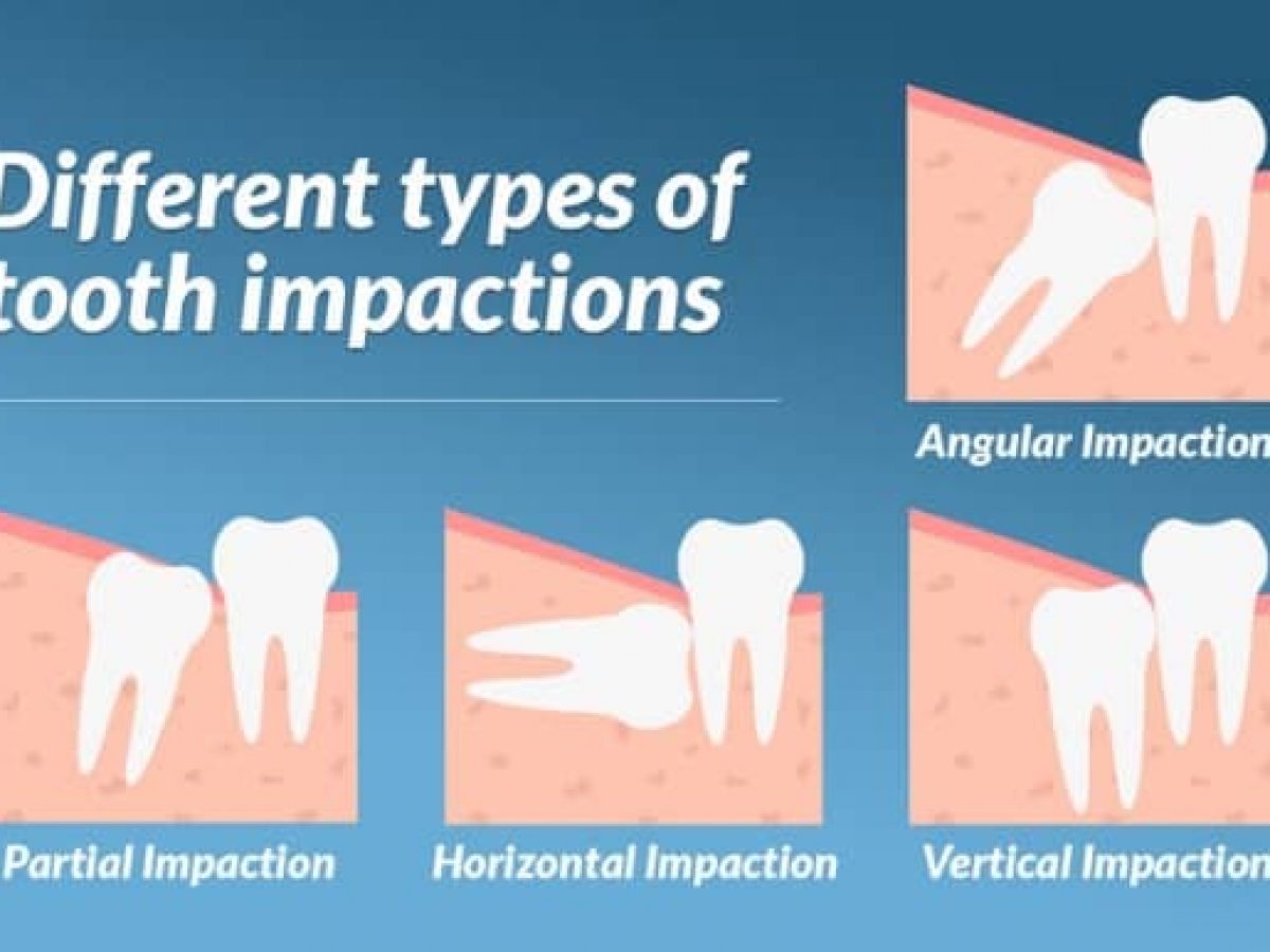 wisdom teeth healing