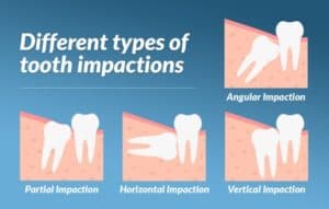 période de récupération de l'extraction des dents de sagesse