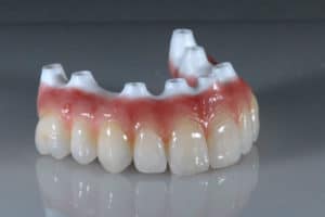 dientes en un día todo en 4 implantes