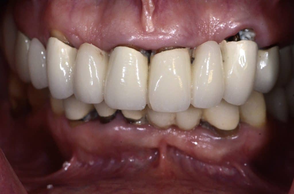 One Day Implant Problems