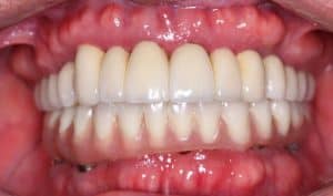 full mouth implants same day problems