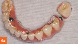 acrylic hybrid denture