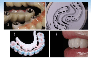 all on 4 zirconia vs acrylic teeth