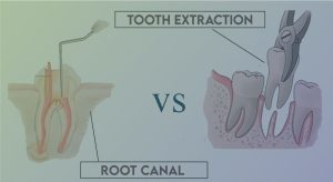root canal vs implant costs