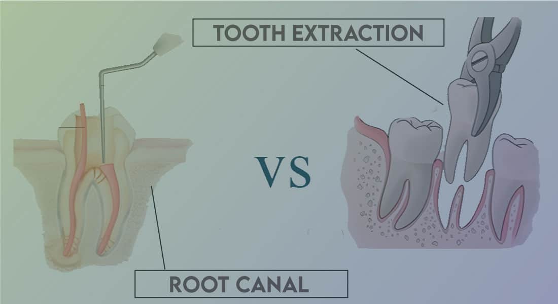 Do Root Canals Cost More Than Implants?