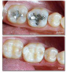 rellenado de amalgama dentista eliminación