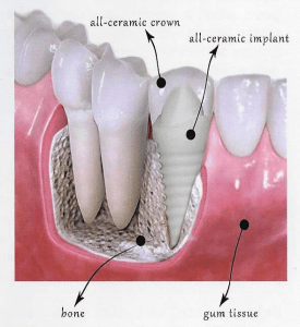 implantes dentales de zirconia-cerámica