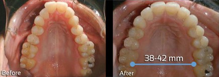 dna appliance sleep apnea