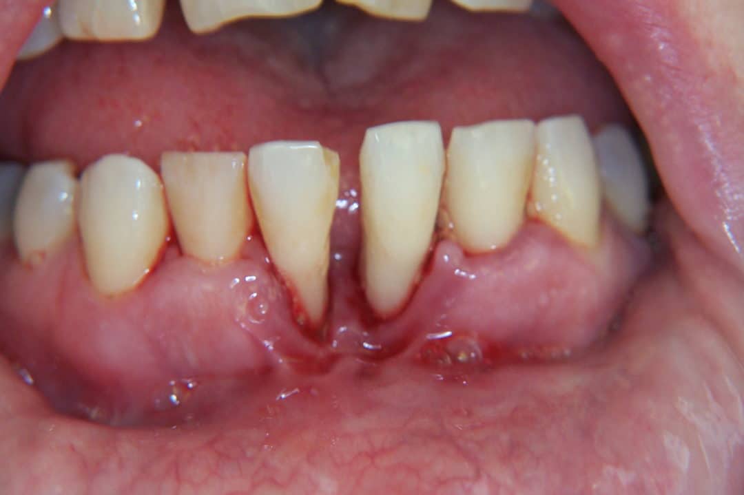 are-dental-implants-possible-with-gum-disease