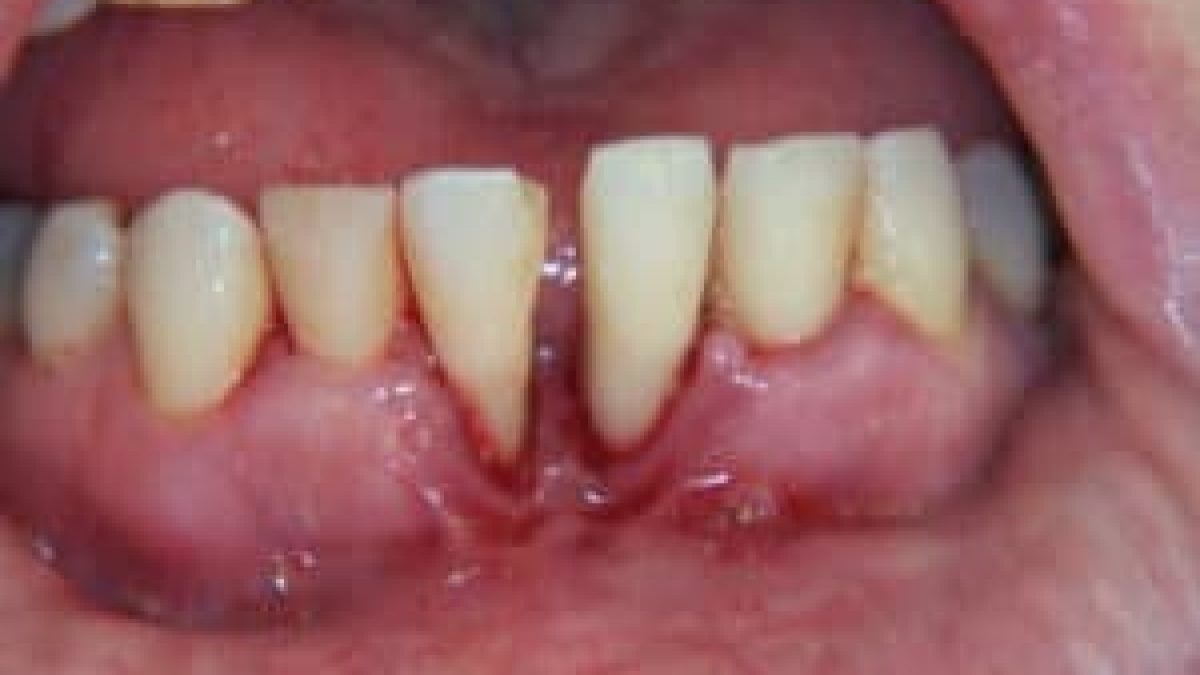 Effective Ways to Avoid Gum And Jaw Bone Diseases