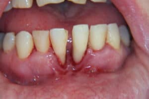 severe gum disease