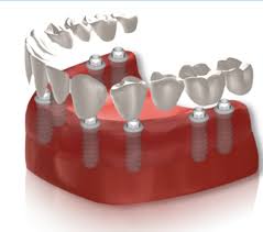 complete individual implants and crowns