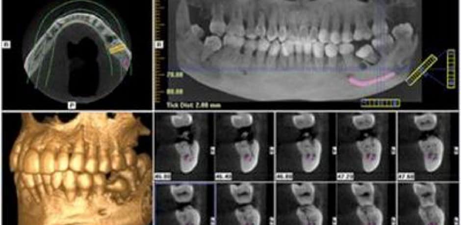 dentista dental del implante 