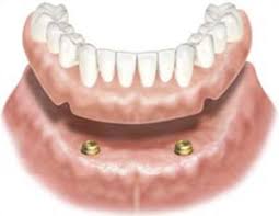 How to Apply DenSureFit to IMPLANT-RETAINED (snap-in) Dentures