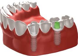 implant tooth bridge