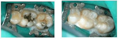 mercury amalgam removal dentist