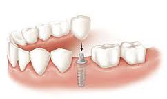 single implant crown