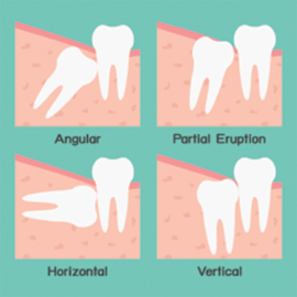 Melbourne Wisdom Teeth Removal