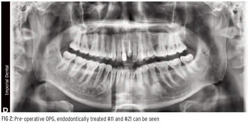 Consider Homeoblock and DNA Appliances to Jaw Surgery