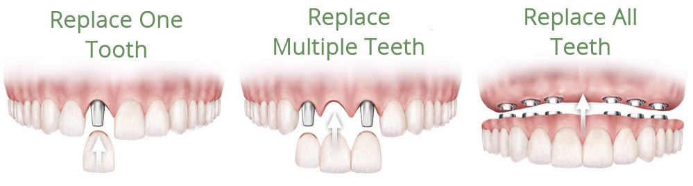 Holistic dental implants