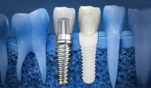 Zirconia implante dentista