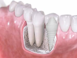 pain after dental implant surgery normal