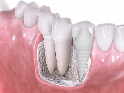 How Long Does It Take For Dental Implants To Heal 