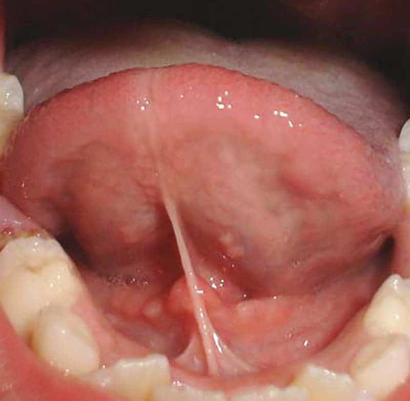 alf device dentist