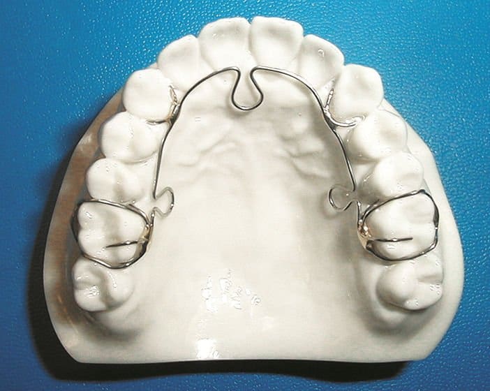 ALF Expander Appliance is Alternative to Orthodontics