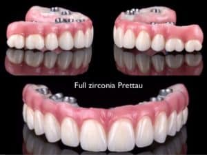 all on 4 cost vs snap on denture costs