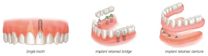 How Much Does A Full Mouth Of Dental Implants Cost