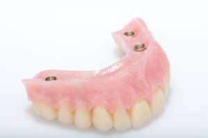Opciones de implante de boca completa