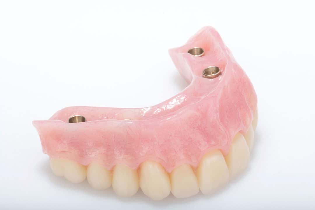 full mouth implants