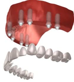 full mouth implant cost vs all on 4 cost