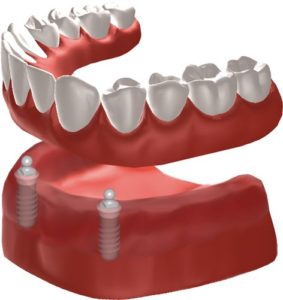 implant dentures vs dentures