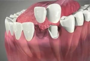 implant bridge