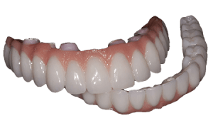 Are Permanent Dentures the Same as Implants?